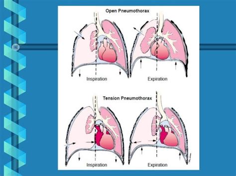 2. chest tube drainage