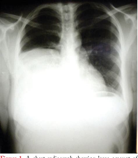 Figure From Spontaneous Massive Hemothorax Related To A Neurofibroma