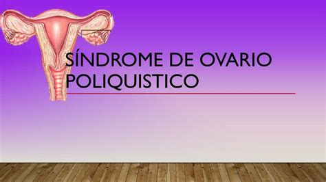Síndrome de ovario poliquistico | Sammy Arshel | uDocz