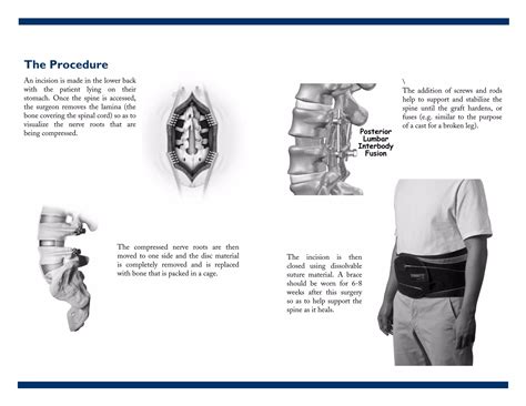 Posterior Lumbar Interbody Fusion Plif Ppt