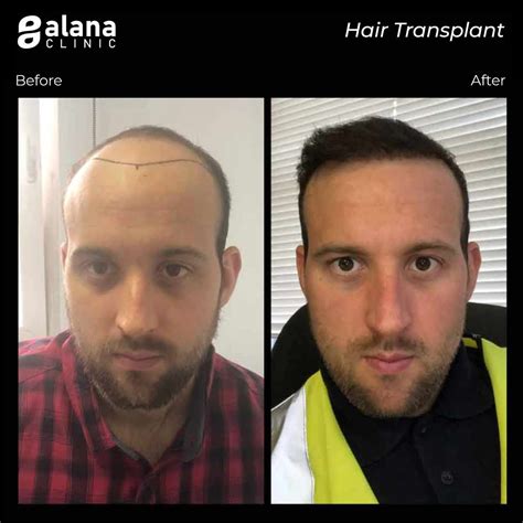 FUE Hair Transplant Turkey - Alana Hair Clinic