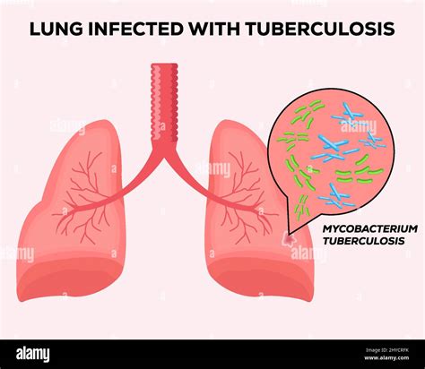 Human Lungs Infected With Tuberculosis Stock Vector Image And Art Alamy