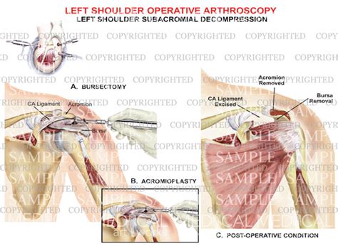 Left shoulder arthroscopic repair - Subacromial decompression — Medical Art Works