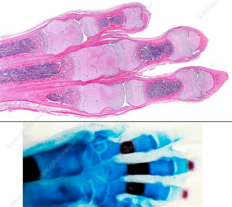 ossification  hand bones light micrographs stock image