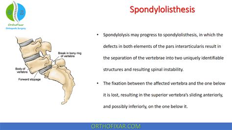 Spondylolisthesis: Causes, Symptoms & Treatment | 2025