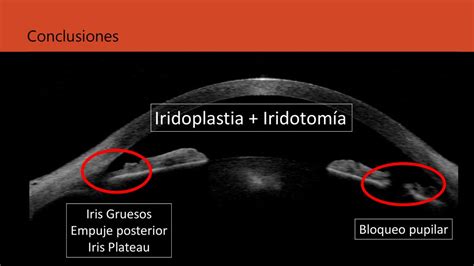 Utilidad De La Iridoplastia Ppt Descargar