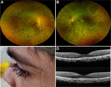 Retinitis Pigmentosa In Oliver McFarlane Syndrome Ophthalmology Retina