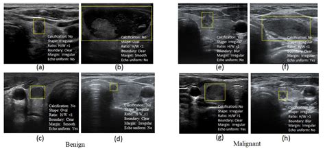 Typical Examples Of Benign And Malignant Thyroid Nodules The Yellow Download Scientific