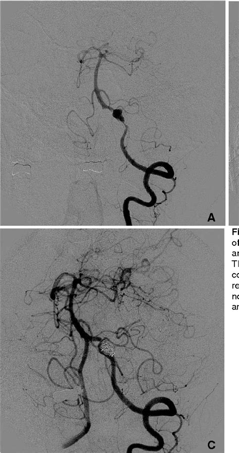 Figure 1 From Endovascular Treatment Of Intracranial Vertebral Artery