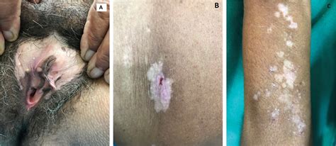 The Convergence Of Extragenital Lichen Sclerosus With Genera