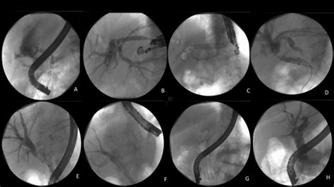 Intraluminal Endoscopic Rendezvous For A Post Cholecystectomy Download Scientific Diagram