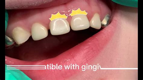 Nusmile Pediatric Anterior Zirconia Crowns 2 Year Follow Up Youtube