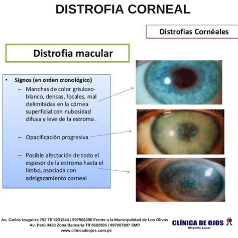 Cl Nica De Ojos Oftalmic L Ser Distrofia Corneal