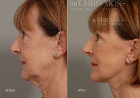 Eyelid Surgery Blepharoplasty Melbourne By Dr Chris Moss