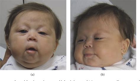 Figure 1 From Anterior Pituitary Aplasia In An Infant With Ring Chromosome 18p Deletion