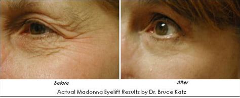 Madonna Eye Lift Treatment Eve Clinics Leamington Spa