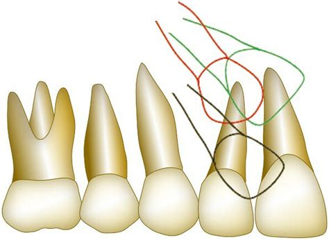 Orthodontic Correction Of Maxillary Canine Lateral Incisor