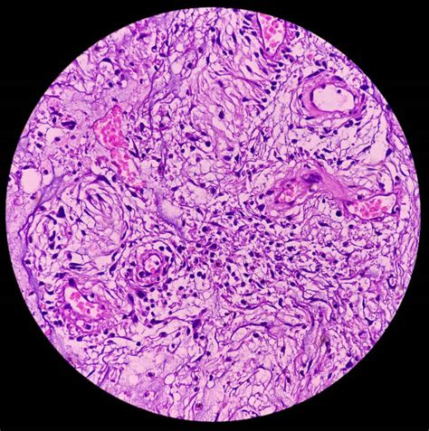 Salivary mucoid cyst. microscopic show parotid tissue, features of cyst ...