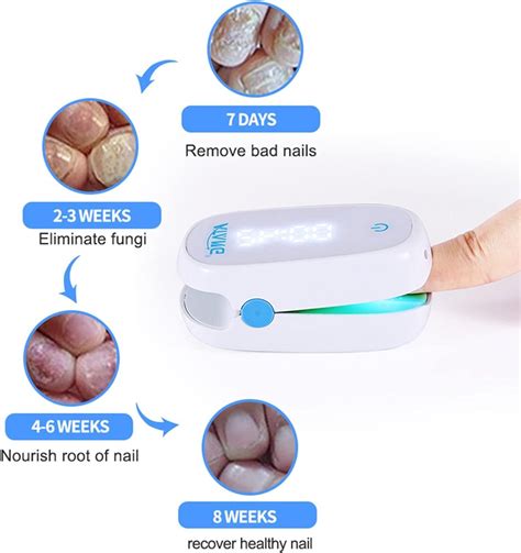 Atang Nail Fungus Laser Therapy Device Nm Nm Toenail Fungal