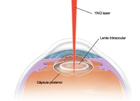 Capsulotomia por laser YAG o que é