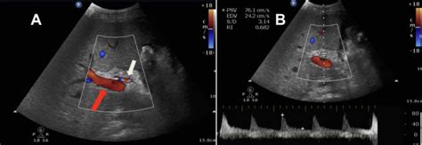 Hepatic Artery Ultrasound