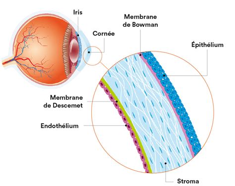 Dystrophie Corn Enne Entrevoir