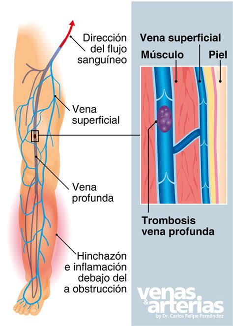 Cuándo visitar un cirujano vascular Clínica de Várices en Caracas