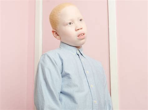 Albinism in humans Pictures – 26 Photos & Images / illnessee.com