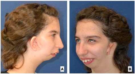 Use Of A Fibula Free Flap For Mandibular Reconstruction In Severe Craniofacial Microsomia In