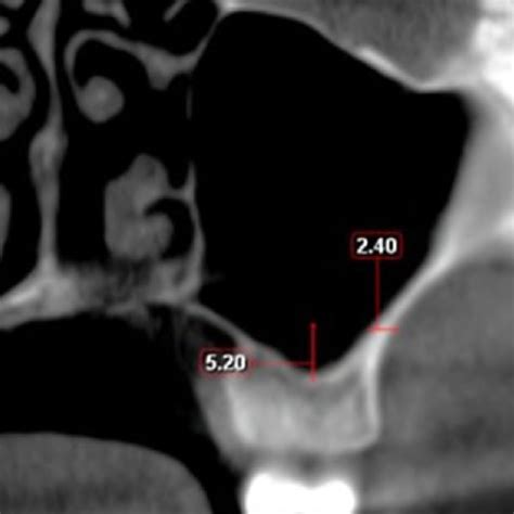 Psaa Distance From Maxillary Sinus Floor Download Scientific Diagram