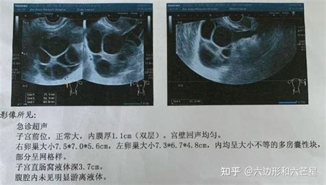 多囊卵巢备孕日记（促排3次卵巢过度刺激妊娠期糖尿病） 知乎