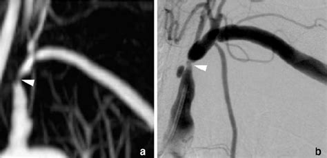 Typical Example Of A Subclavian Artery Stenosis Ini Tially Detected Download Scientific