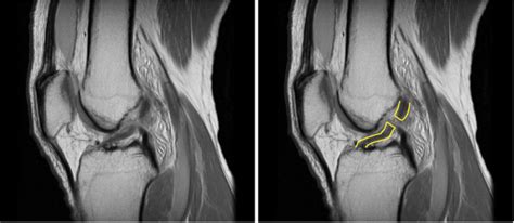 Ligament Injuries and ACL Reconstruction - Dr. Bu Balalla