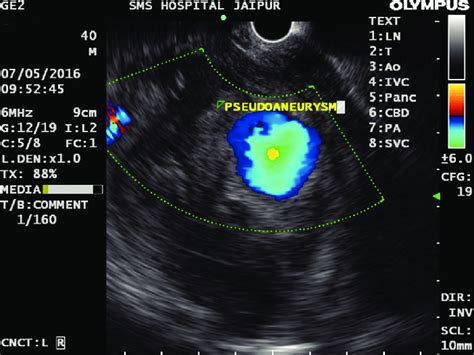 Endoscopic ultrasound shows pseudoaneurysm of gastroduodenal artery ...