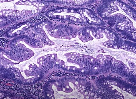 Novel protective factors identified for serrated polyposis syndrome