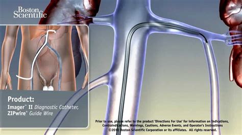 Fis Varicocele Embolization Youtube