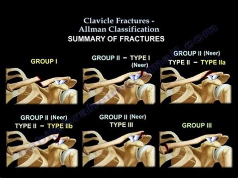 Clavicle Fractures Classification Everything You Need To Know Dr