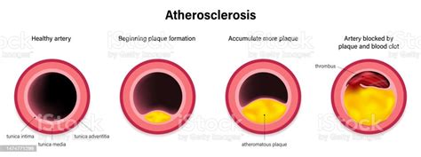 Ilustración De Etapa Del Vector De Aterosclerosis Síndrome De La