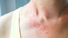 Eczema Scars Treatment: How to Get Rid of Eczema Scarring - AWD Med