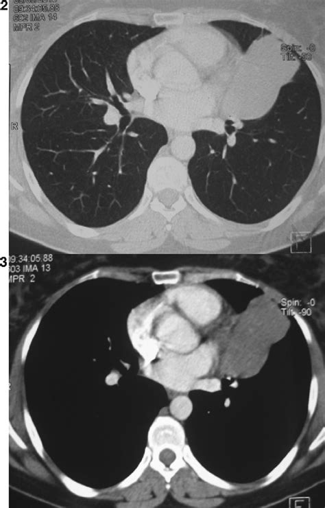 Well Differentiated Fetal Adenocarcinoma A Very Uncommon Malignant Lung Tumor Pulmonology