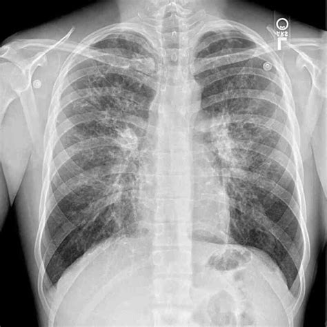 Pulmonary Fibrosis X Ray