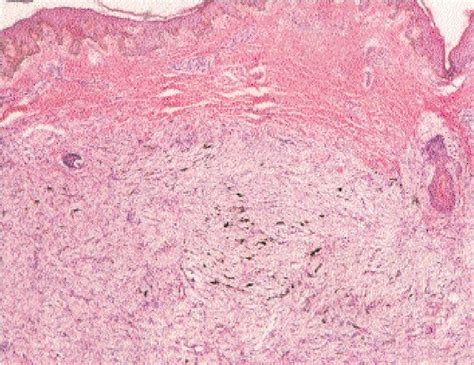 Dermatofibrosarcoma Protuberans Histology