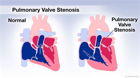 Pulmonary Valves