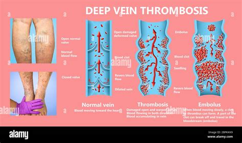 Deep Vein Thrombosis Or Blood Clots Embolus Structure Of Normal And