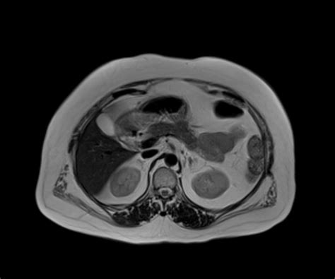 Abdominal Mri Anatomy