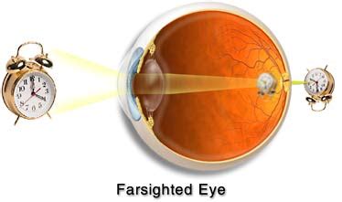 Farsighted Eye