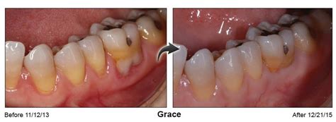 Pinhole Gum Surgery In Cody Wy Taylor Dental