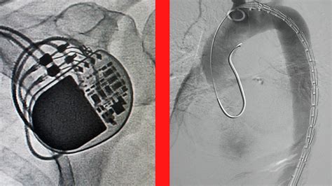 Stent Vs Pacemaker Whats The Difference