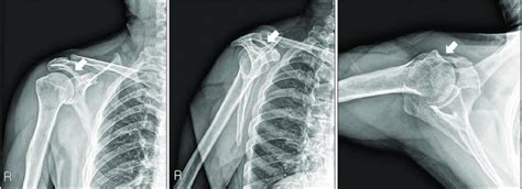 Preoperative Plain Radiographs Shoulder Anteroposterior Supraspinatus