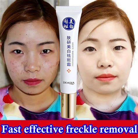 Whitening Cream Quick And Effective Freckle Removal Proniacinamide